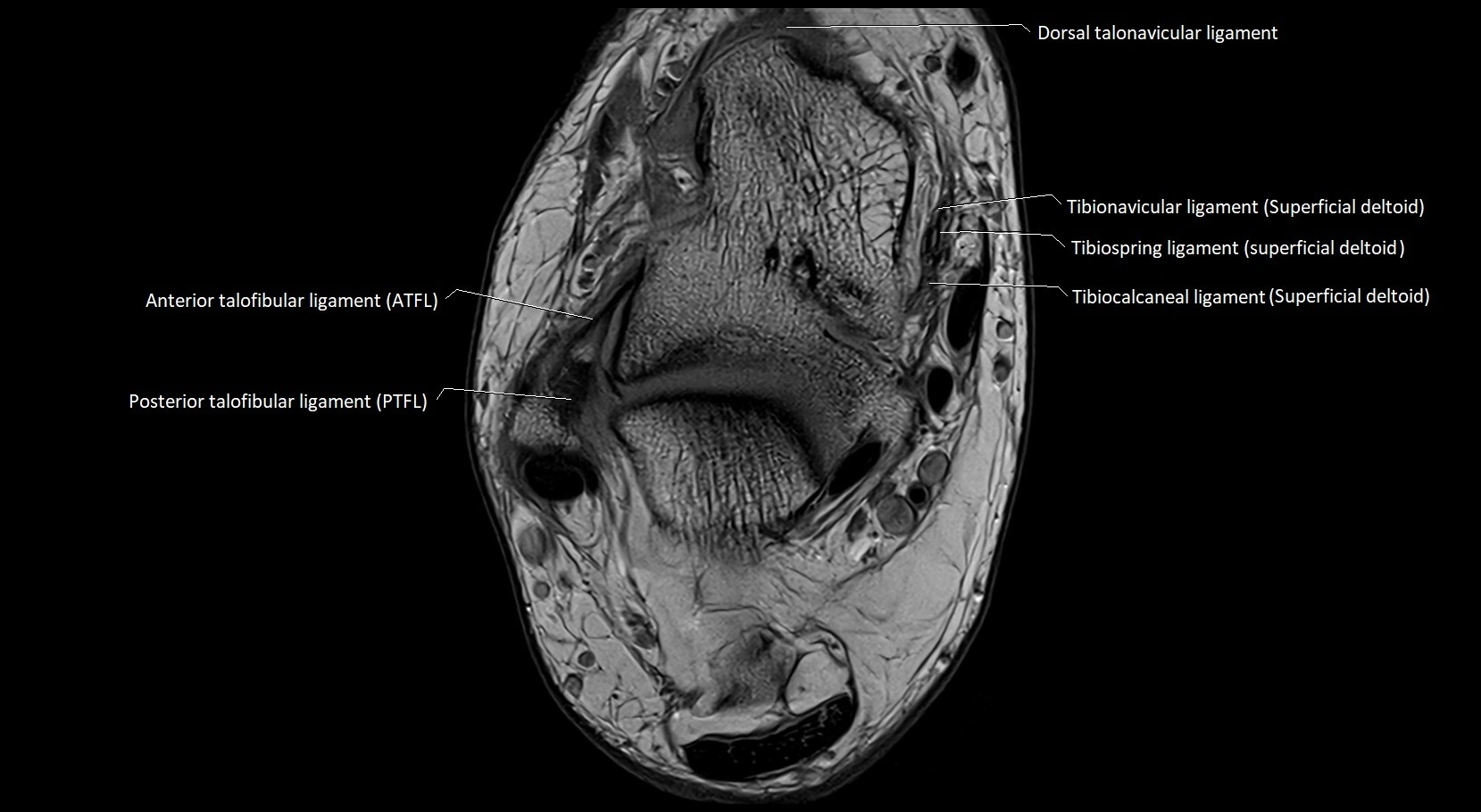 MRI ankle ligaments anatomy axial 3T image 12.webp
